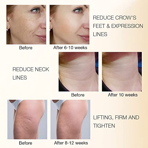 MLAY RF Radio Frequency Facial Massager for Women, Safe for Sensitive Skin | Wrinkle Removal | Skin Rejuvenate | Anti Aging | Tighten Firm Face Eye Neck Arm Thigh Stomach Legs Skin Care Set